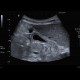 Hepatitis, lues: US - Ultrasound